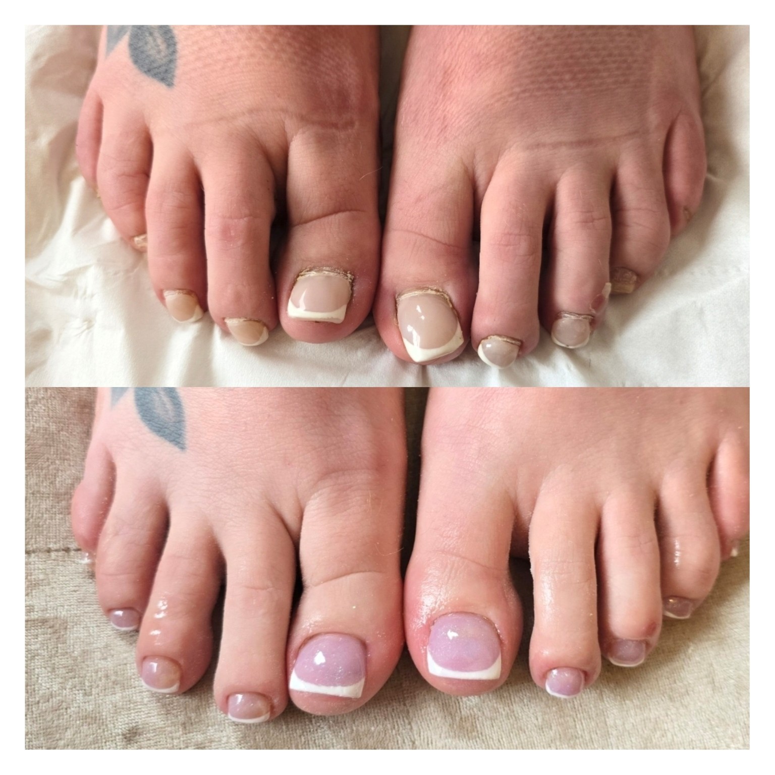 Toenail Reconstruction · Before & After